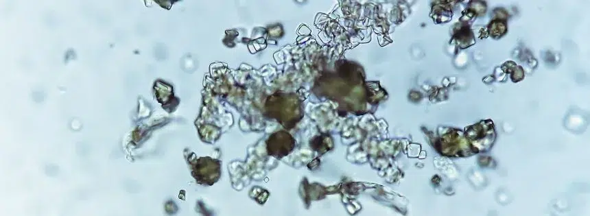 oxalate crystals